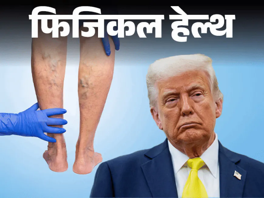 डोनाल्ड ट्रम्प यांना नसांचा गंभीर आजार:CVI म्हणजे काय, ज्यात नसांना सूज येते, ते टाळण्यासाठी 10 खबरदारी गरजेच्या